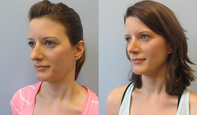 Rhinoplasty Before & After
