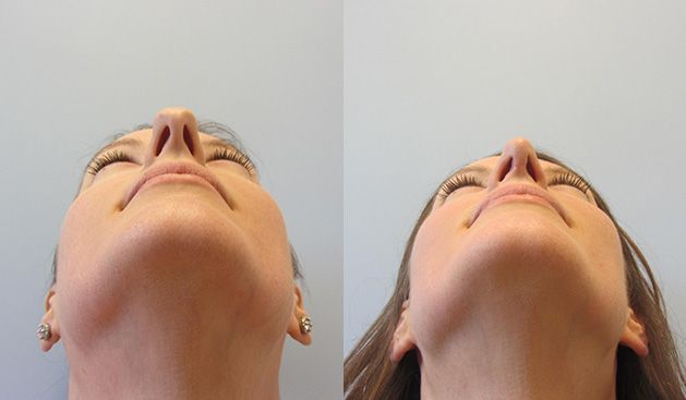 Rhinoplasty Before & After