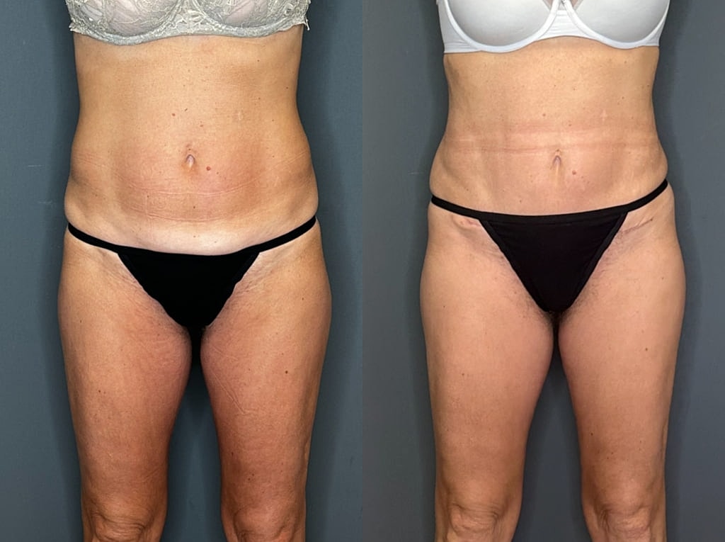 Mini Tummy Tuck Before and Afters Before & After