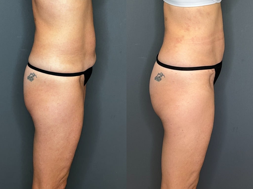 Mini Tummy Tuck Before and Afters Before & After