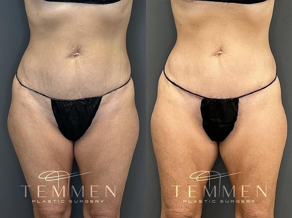 Before and after plastic surgery body transformation.