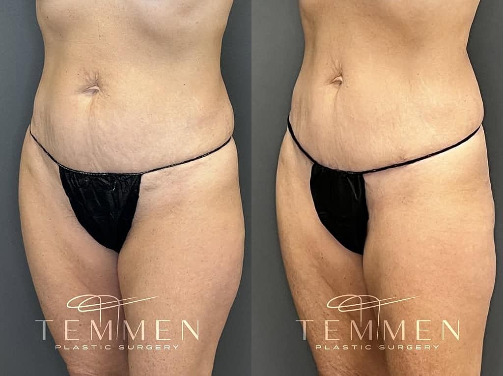 Before and after plastic surgery transformation.