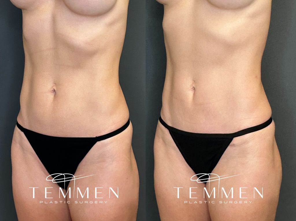 Mini Tummy Tuck Before and Afters Before & After