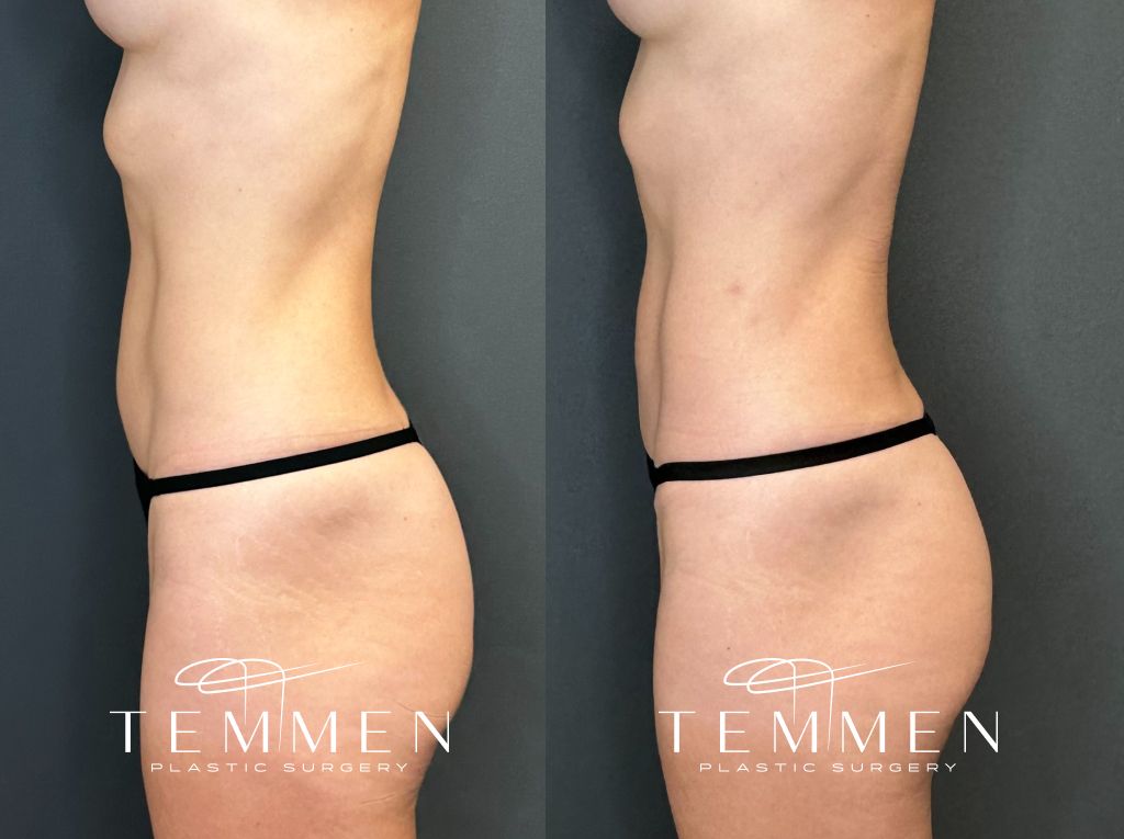 Mini Tummy Tuck Before and Afters Before & After