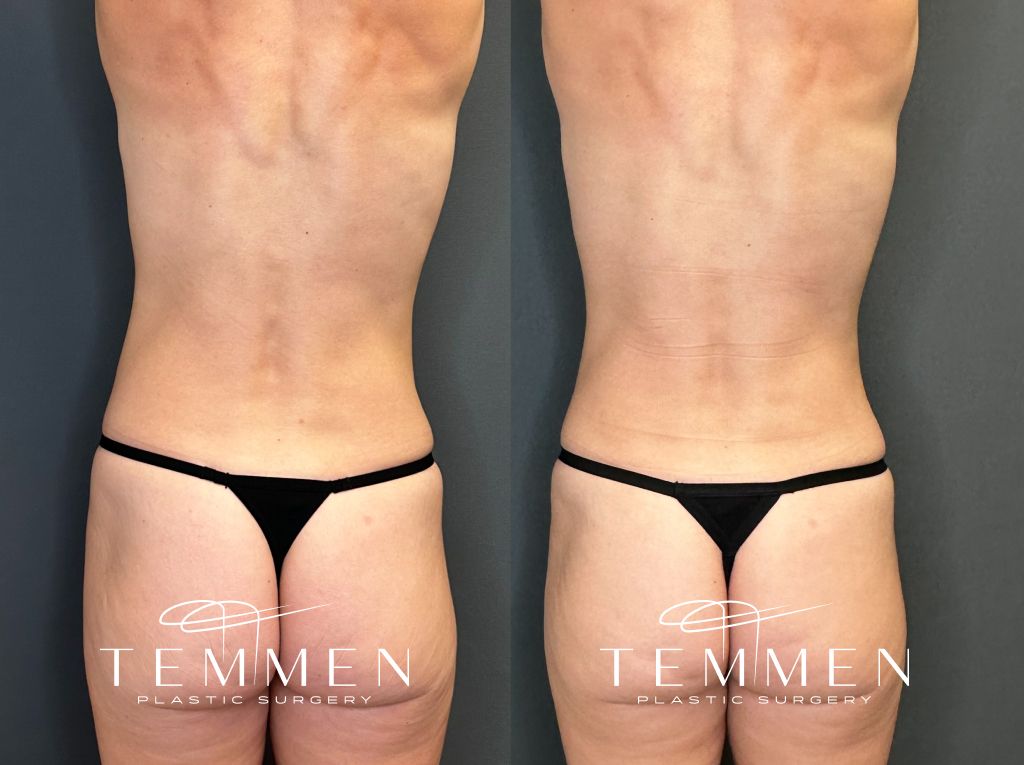 Mini Tummy Tuck Before and Afters Before & After
