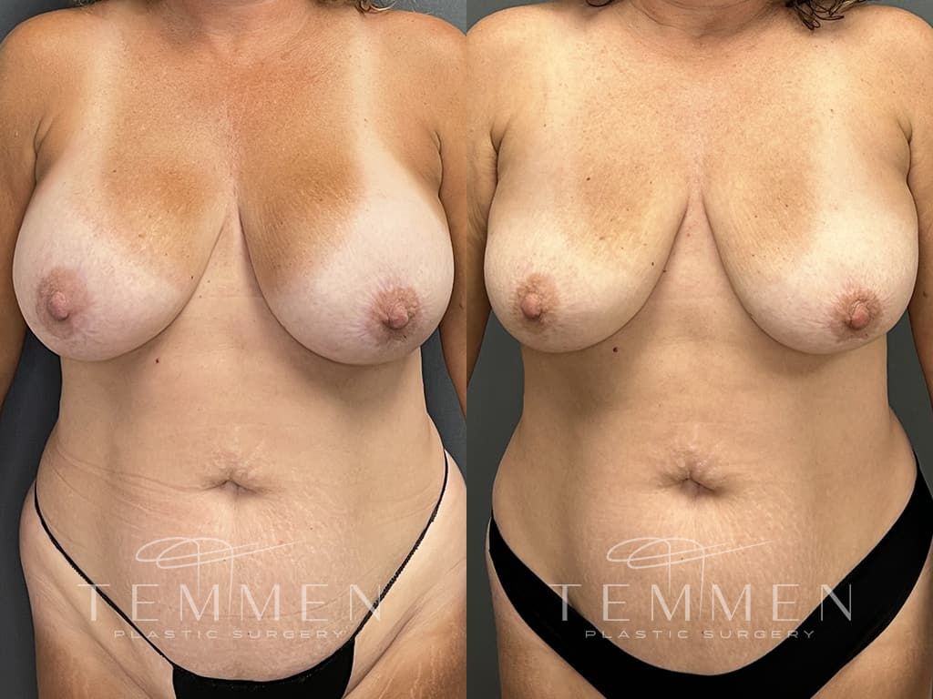 Breast Implant Removal Before & After