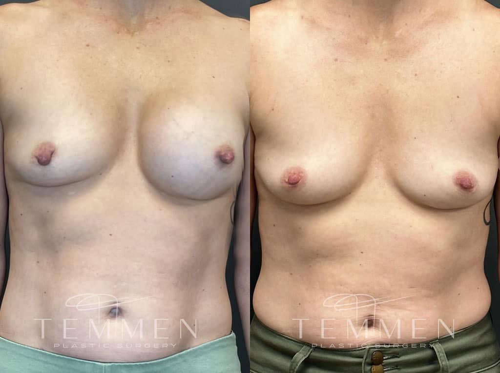 Breast Implant Removal Before & After