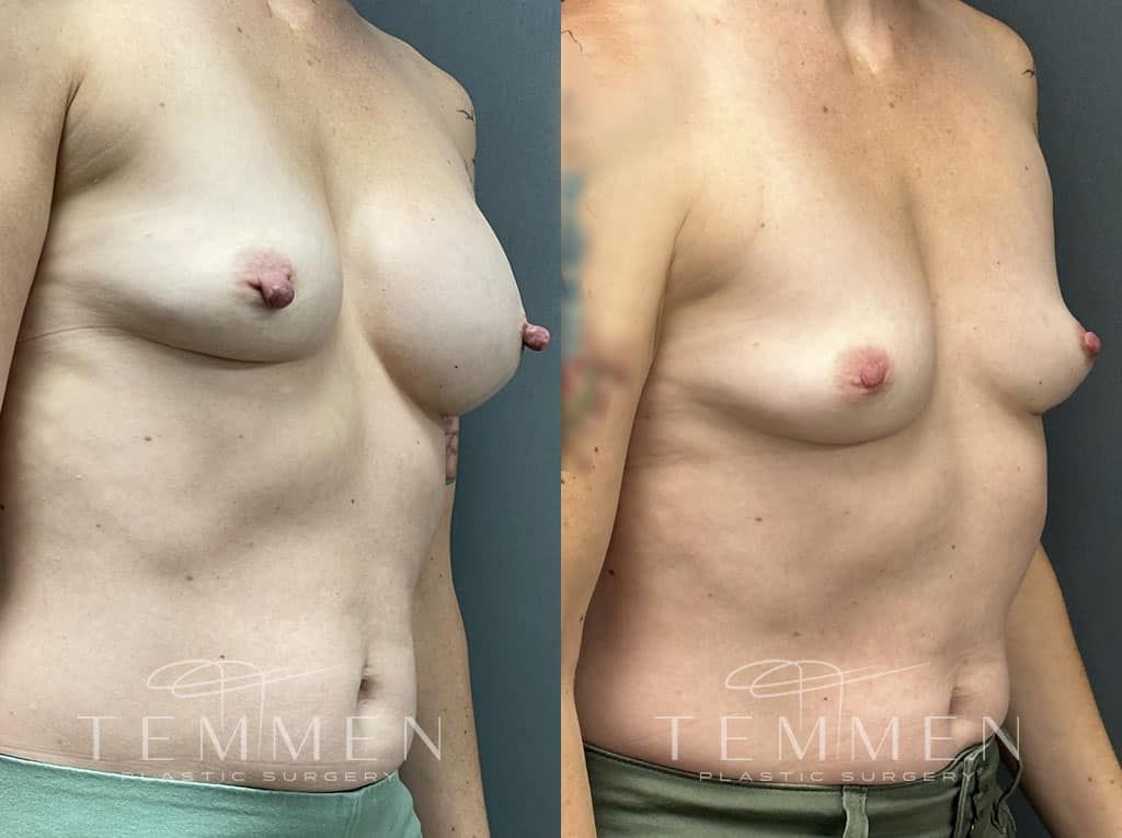 Breast Implant Removal Before & After