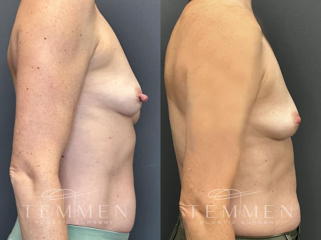 Breast Implant Removal Before & After