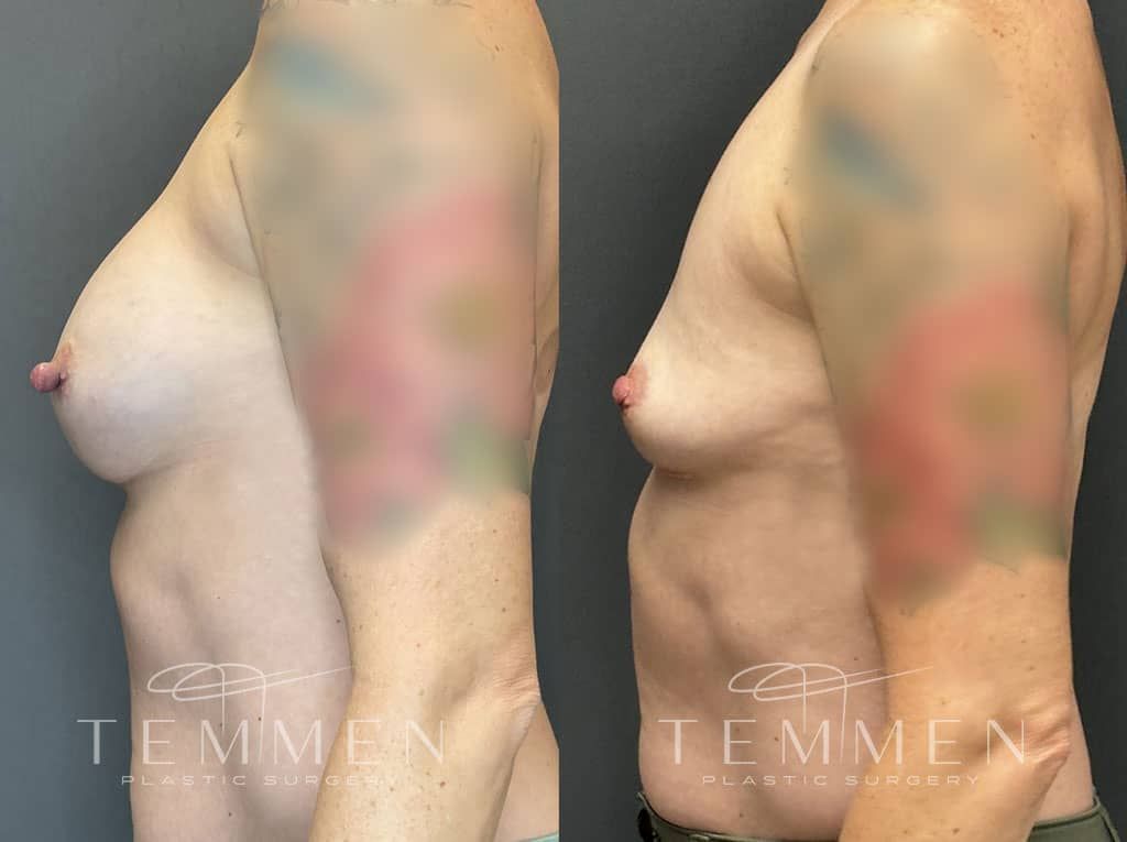 Breast Implant Removal Before & After
