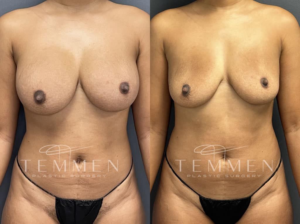 Breast Implant Removal Before & After