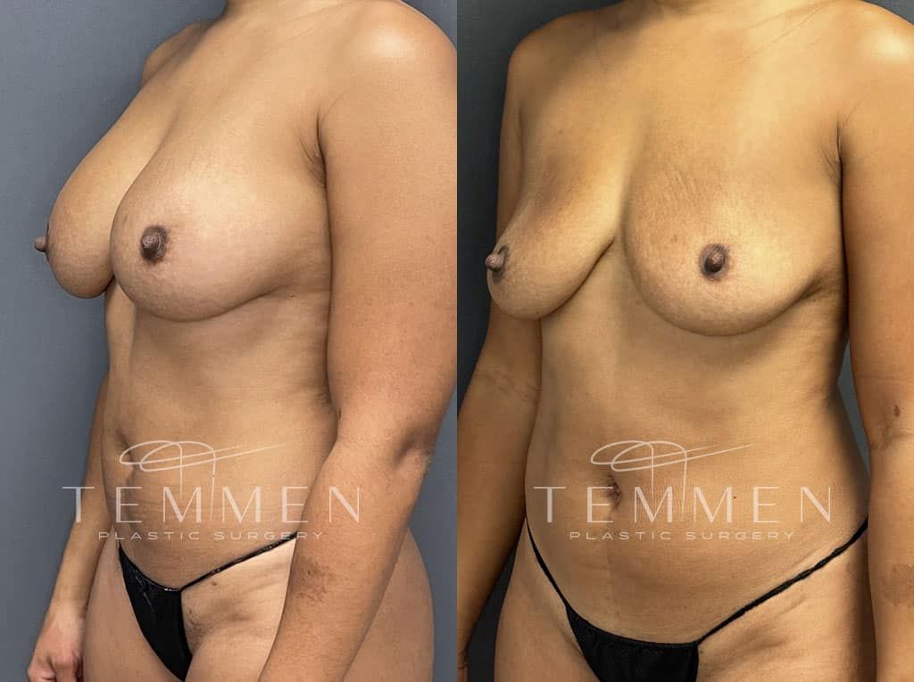 Breast Implant Removal Before & After