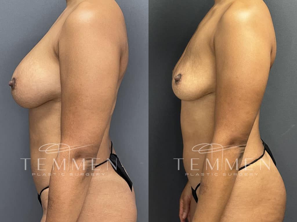 Breast Implant Removal Before & After