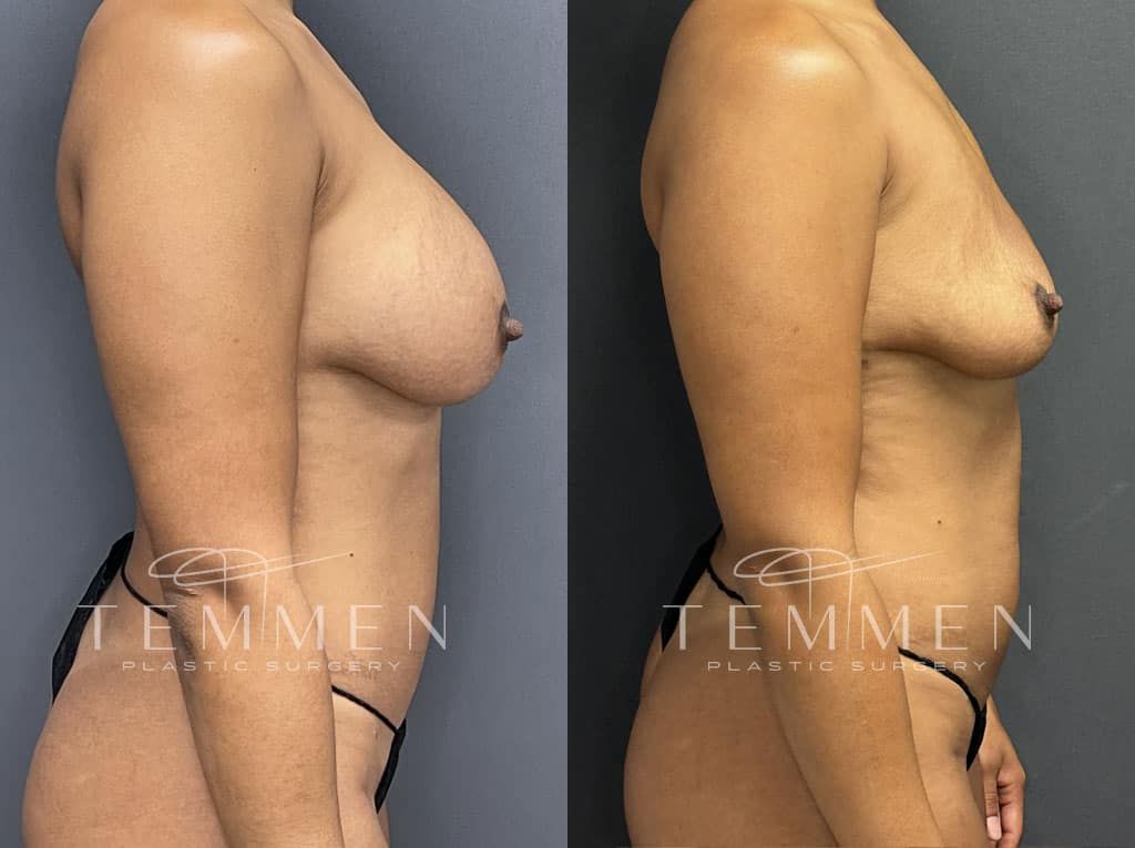 Breast Implant Removal Before & After
