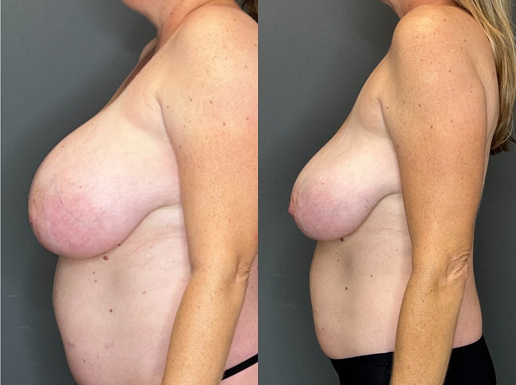 Breast Implant Removal Before & After