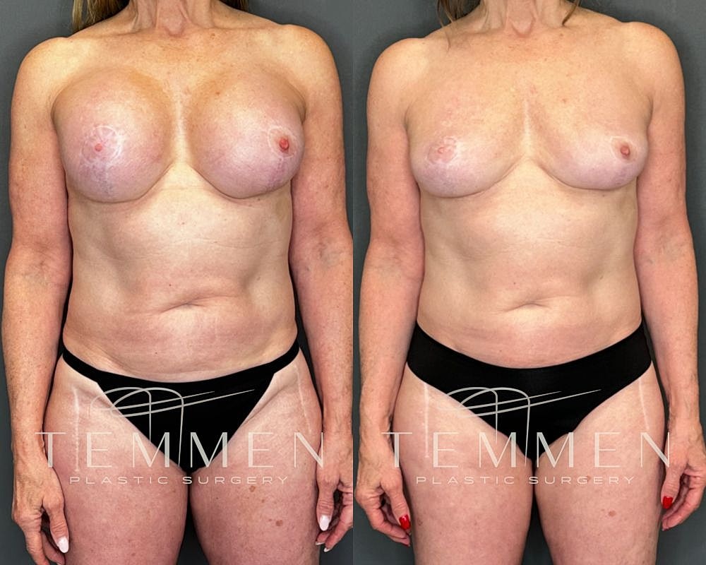 Before and after plastic surgery photo comparison.