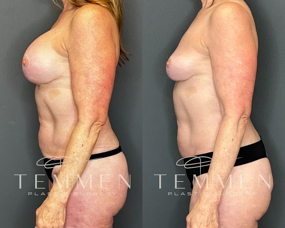 Before and after plastic surgery side profile images