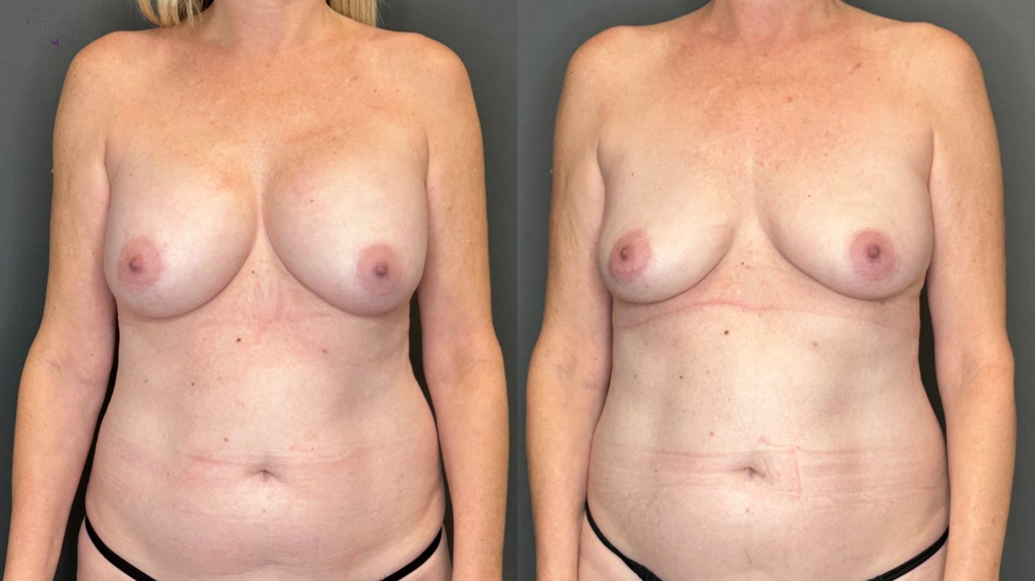 Breast Implant Removal Before & After