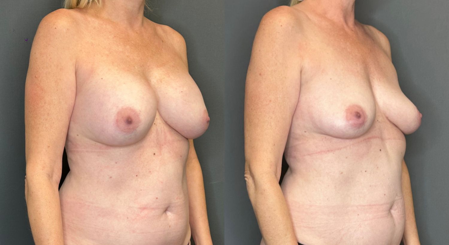 Breast Implant Removal Before & After