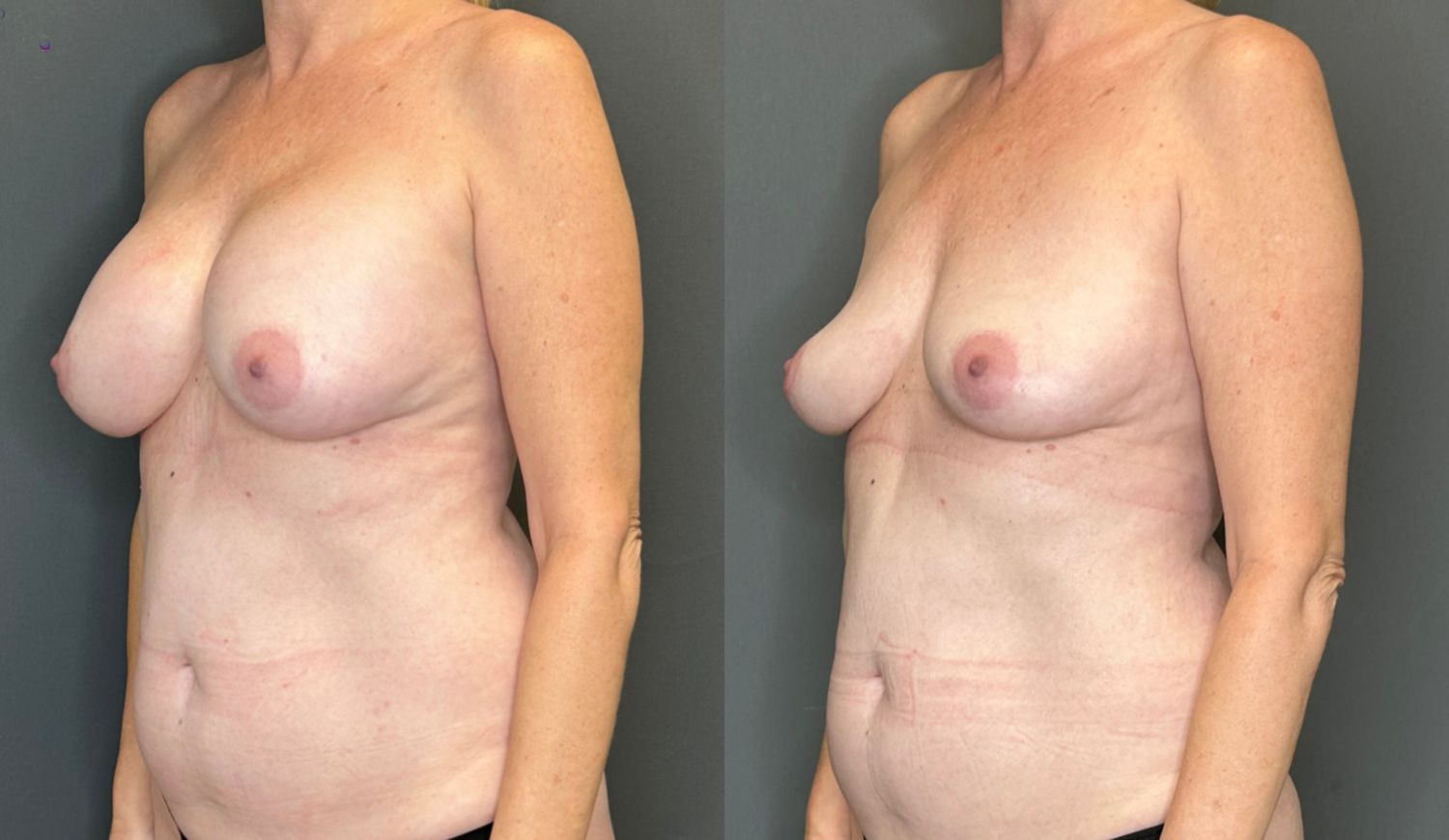 Breast Implant Removal Before & After