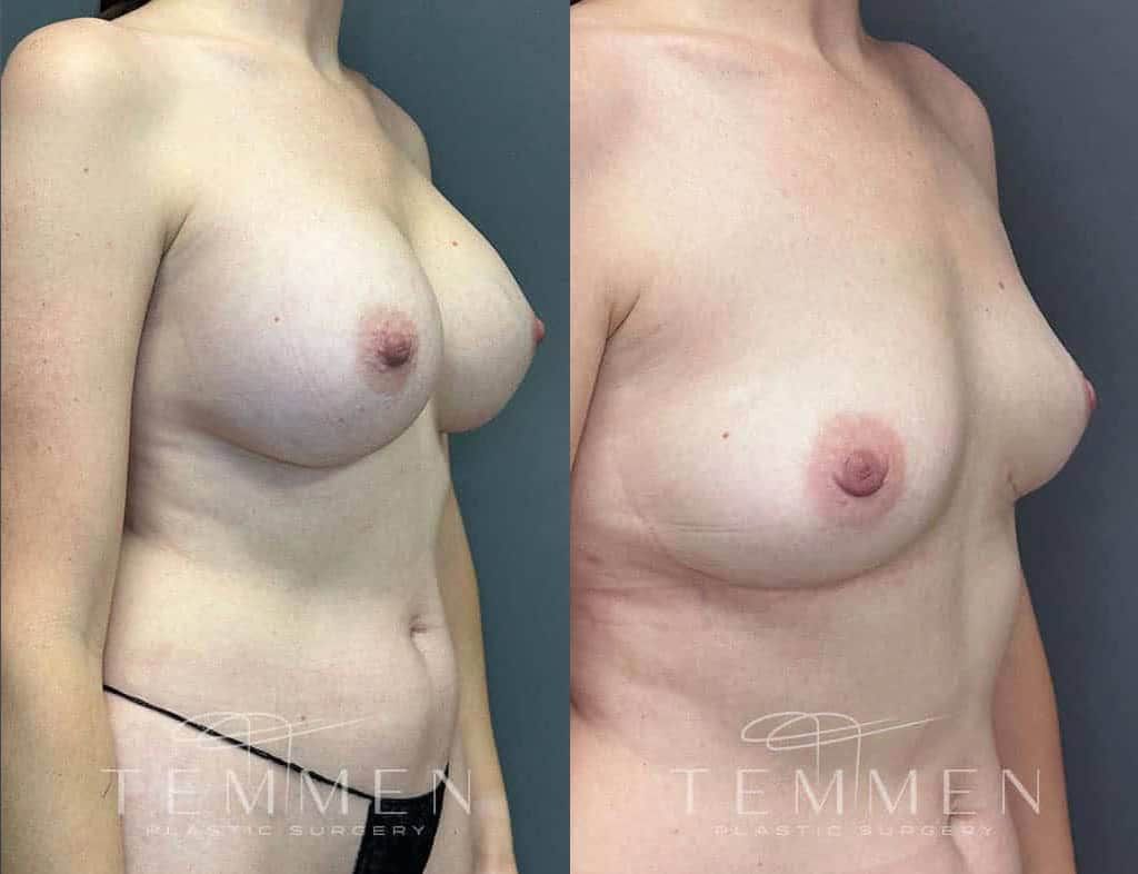 Breast Implant Removal Before & After