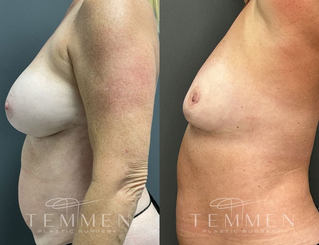 Breast Implant Removal Before & After