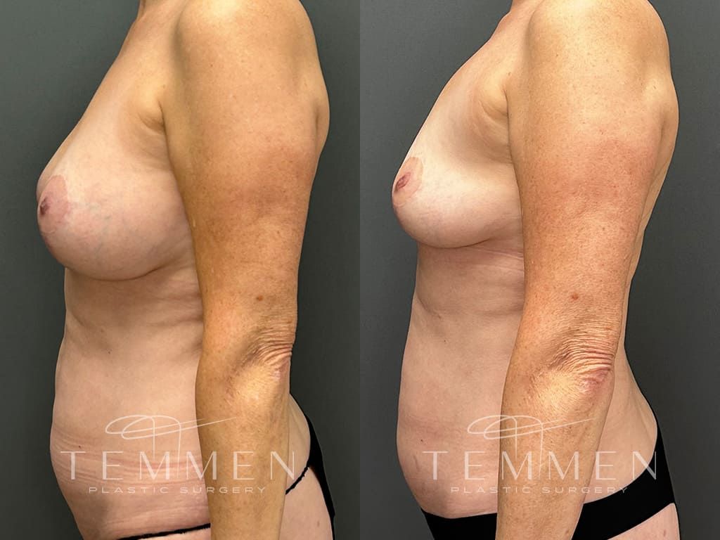 Breast Implant Removal Before & After