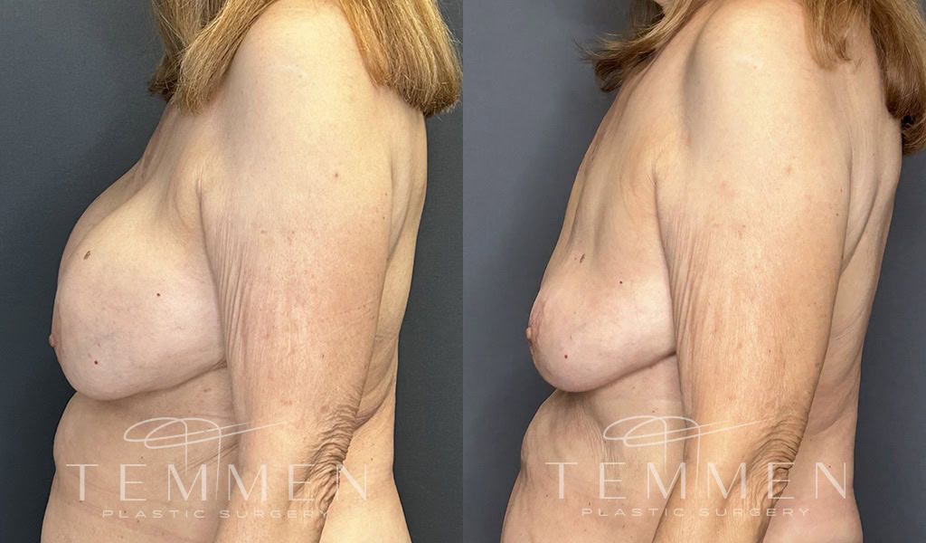 Breast Implant Removal Before & After