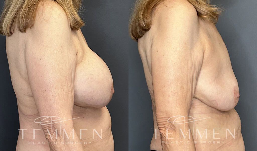 Breast Implant Removal Before & After