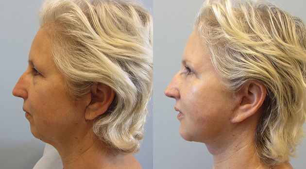 Neck Lift Before & After