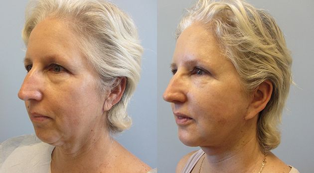 Neck Lift Before & After