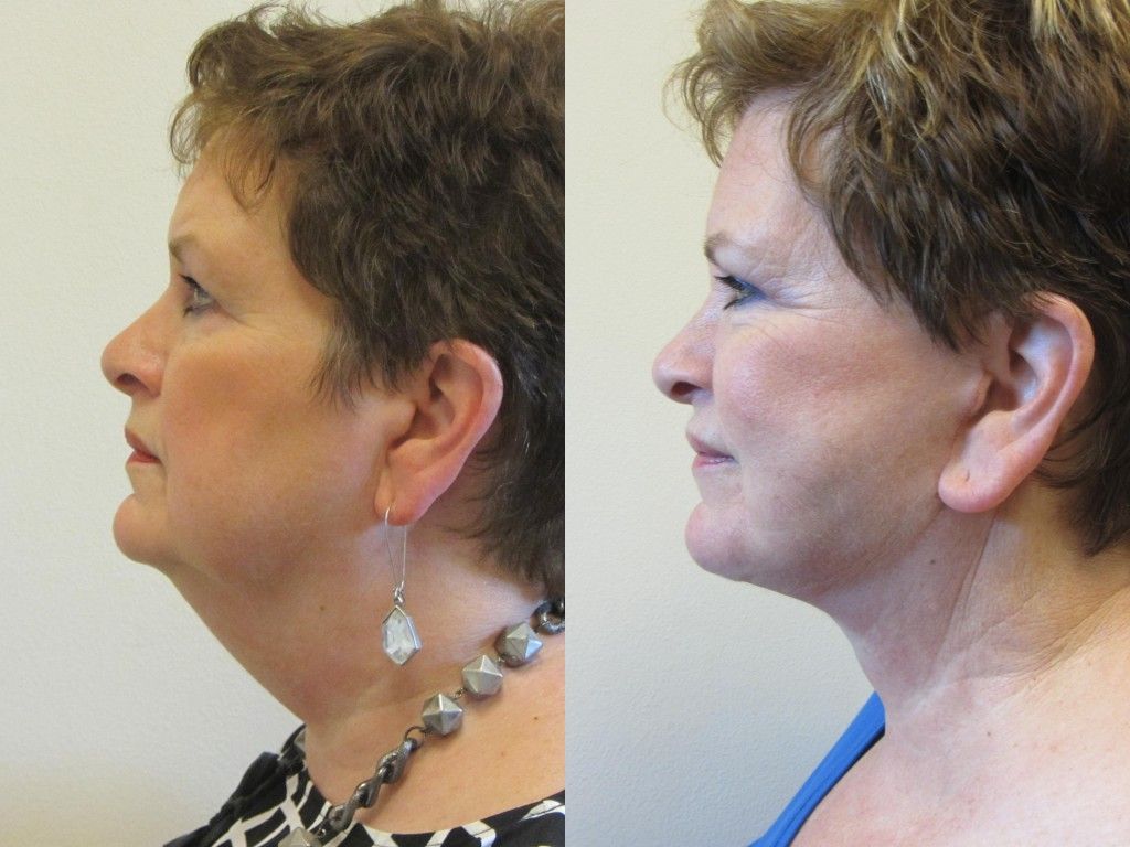 Neck Lift Before & After