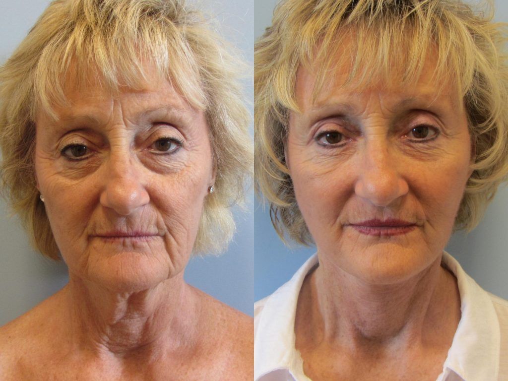 Neck Lift Before & After