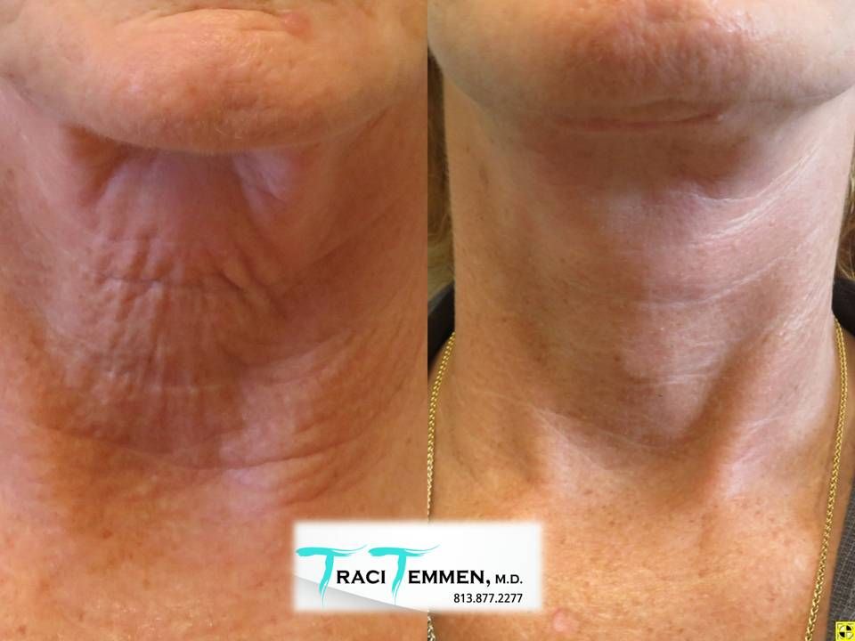 Neck Lift Before & After