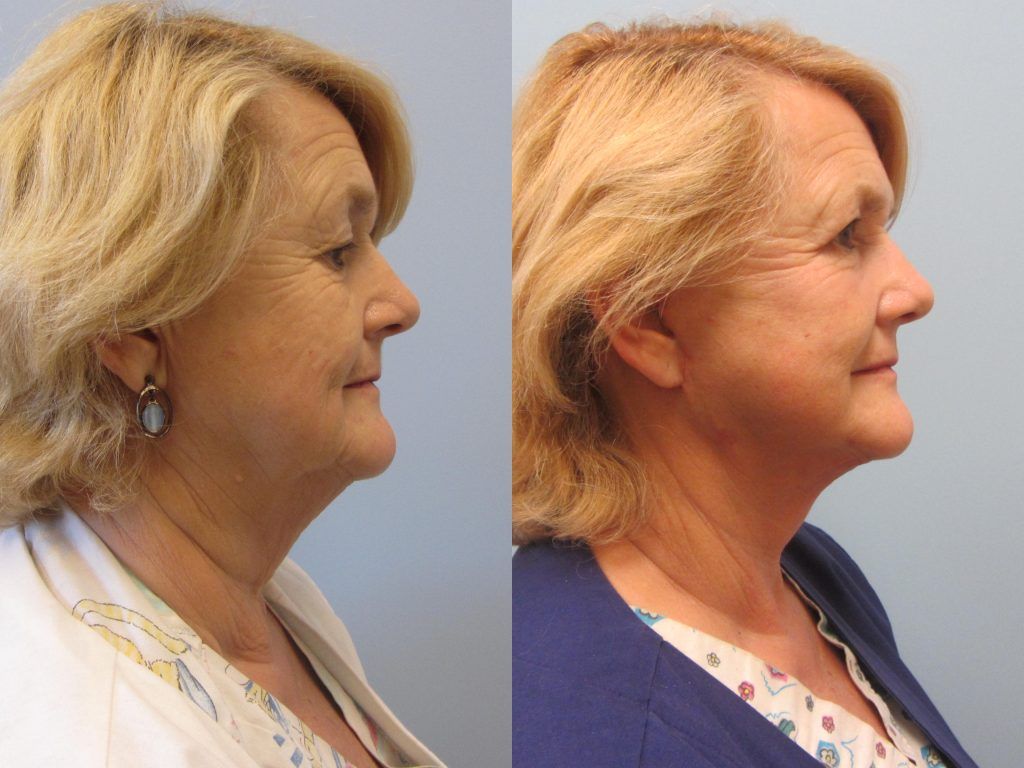 Neck Lift Before & After