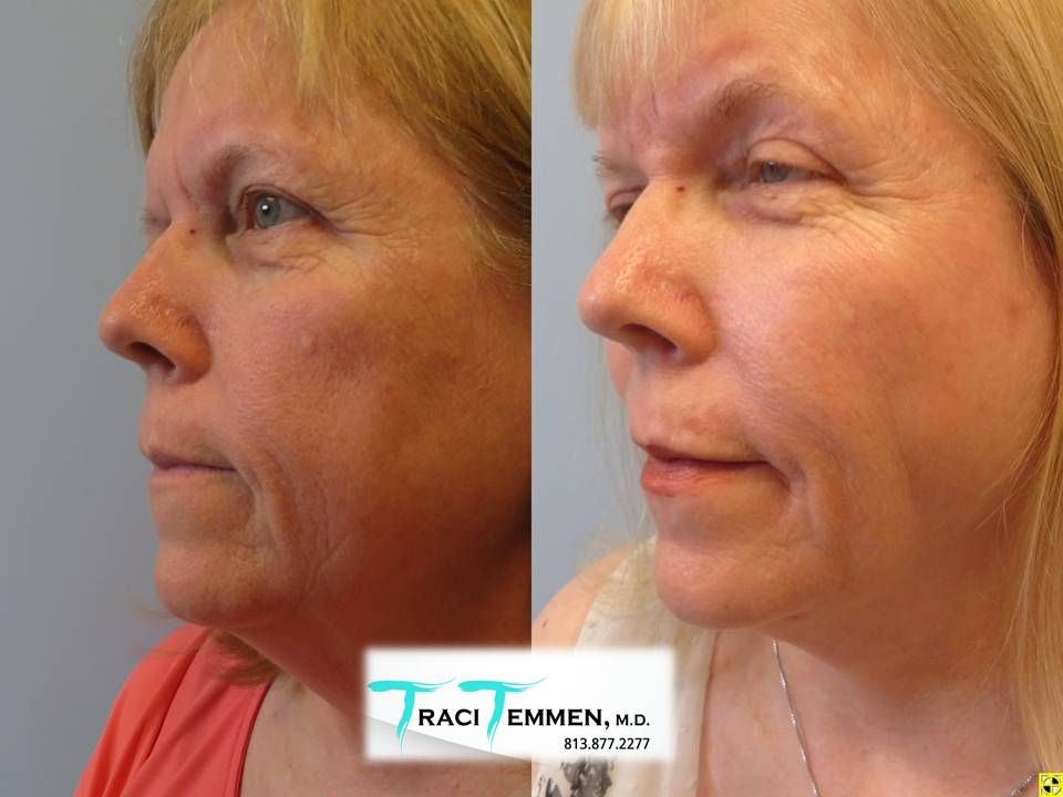 Neck Lift Before & After
