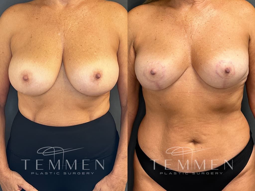 Breast Reduction Before & After