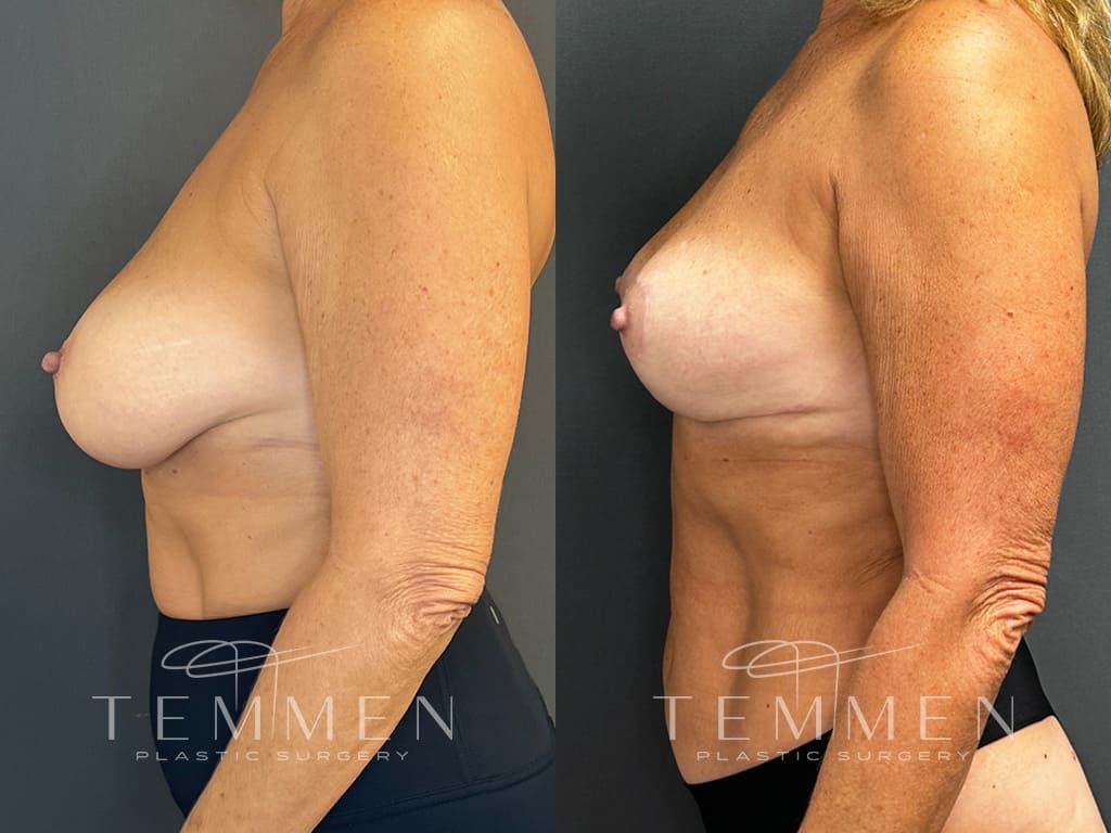 Breast Reduction Before & After
