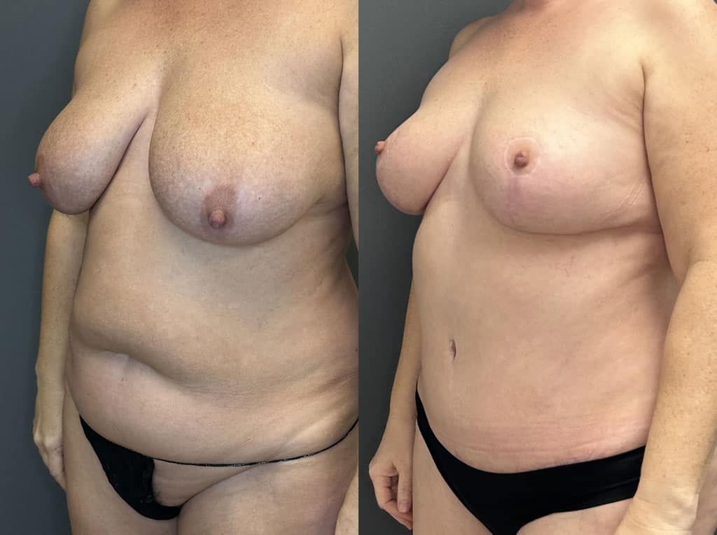 Breast Reduction Before & After