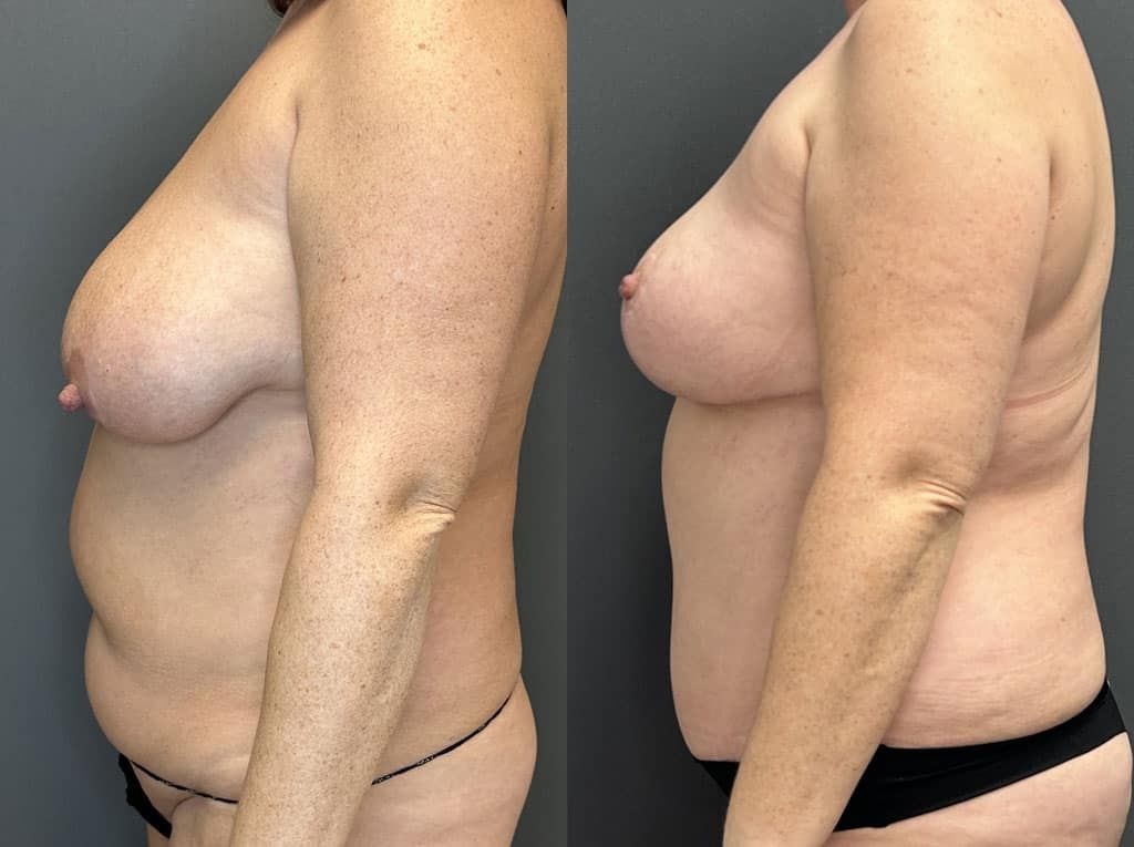 Breast Reduction Before & After