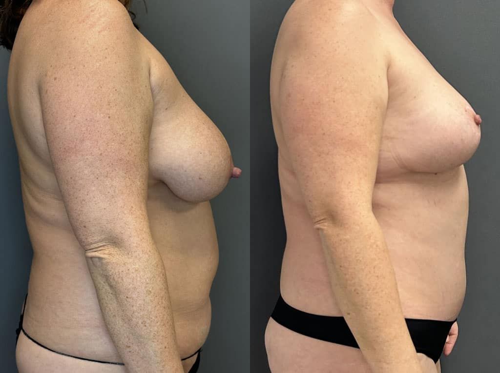 Breast Reduction Before & After