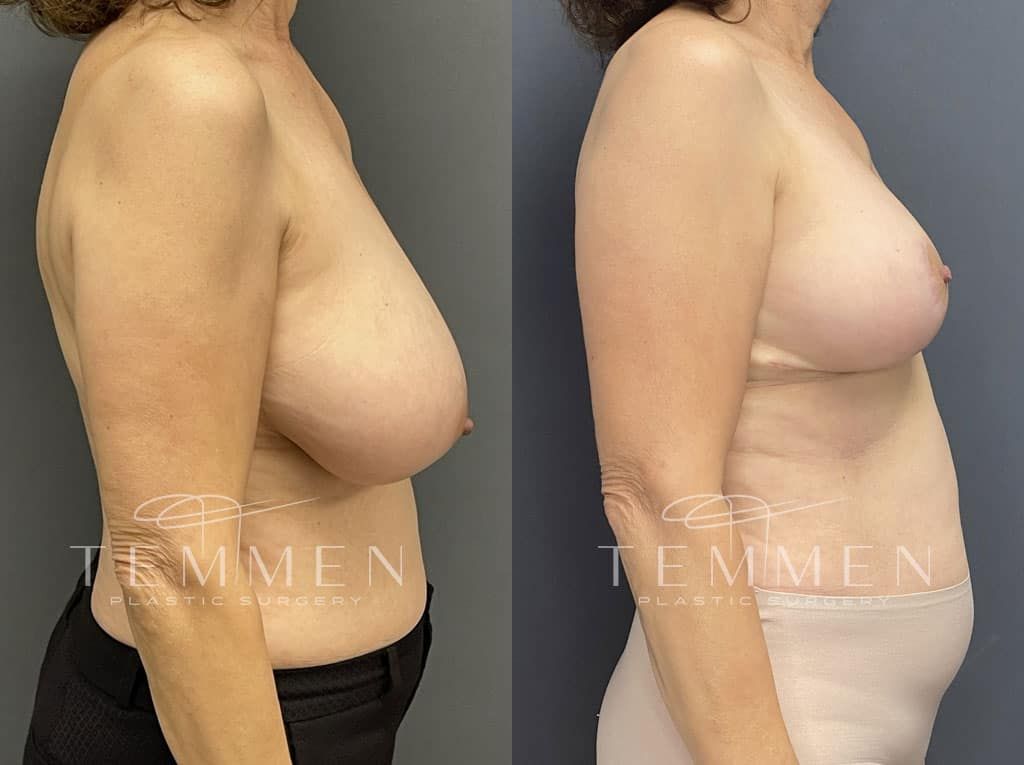 Breast Reduction Before & After