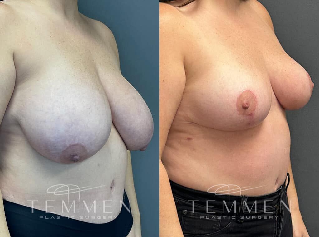 Breast Reduction Before & After
