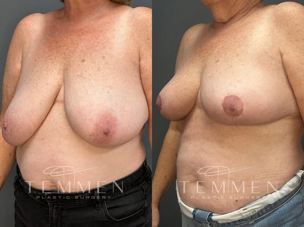 Breast Reduction Before & After