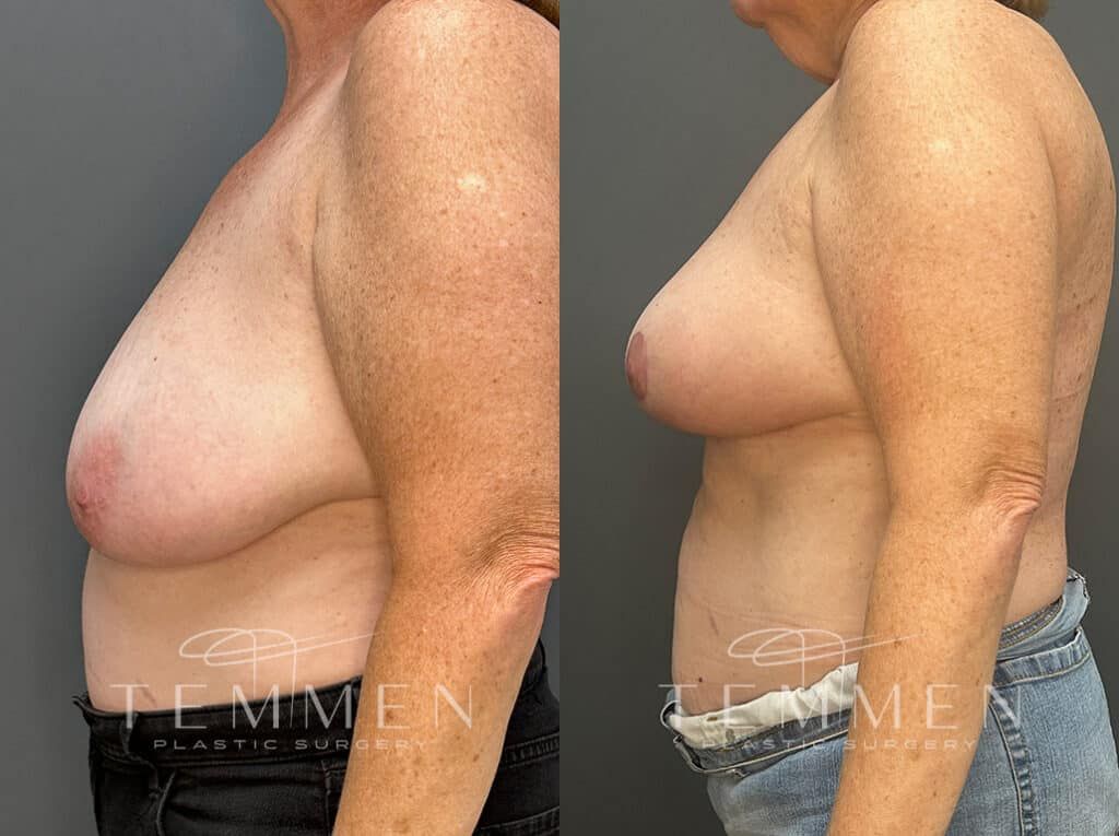 Breast Reduction Before & After