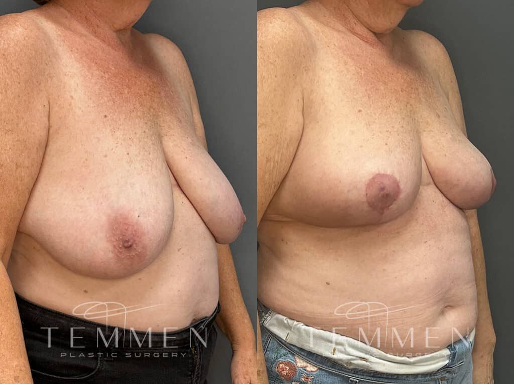 Breast Reduction Before & After