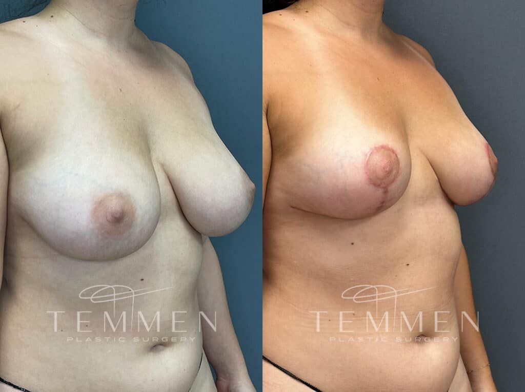 Breast Reduction Before & After