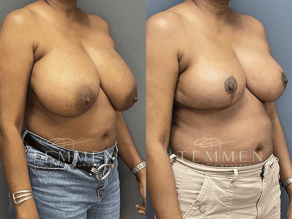 Breast Reduction Before & After