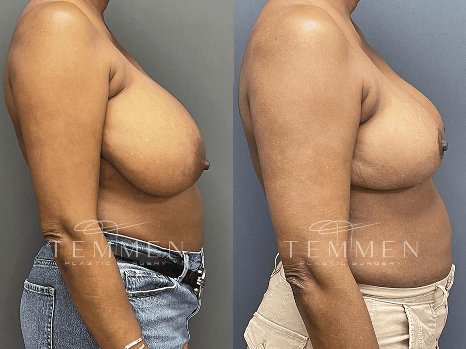 Breast Reduction Before & After