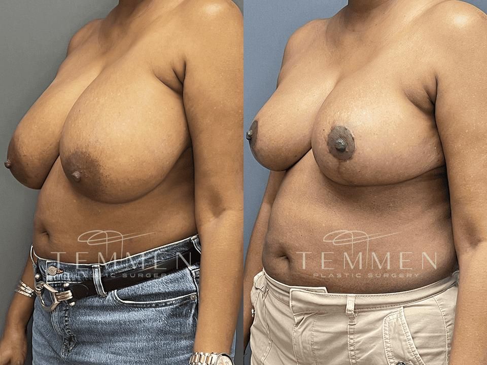 Breast Reduction Before & After